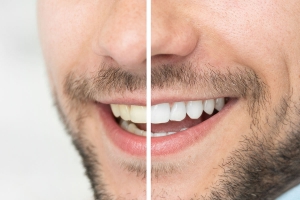 Choosing the Right Whitening Method: A Guide for Residents in Millwoods